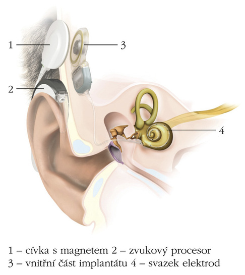 Obr. 2: Schéma kochleárního implantátu 